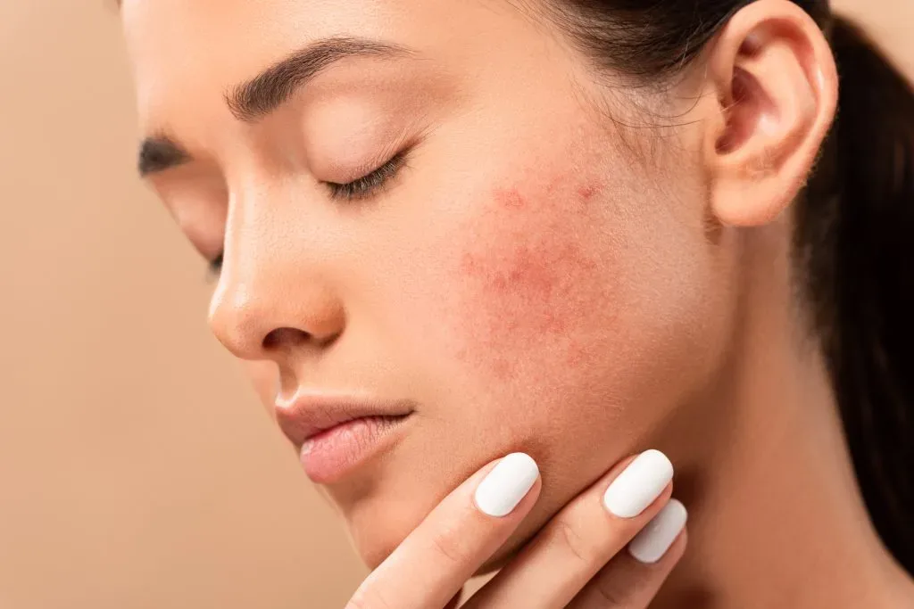 Acne Scar Treatment near johar town Lahore | The Skin Care Studio