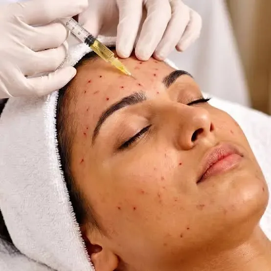 PRP Skin Treatment in Johar Town Lahore | The Skin Care Studio