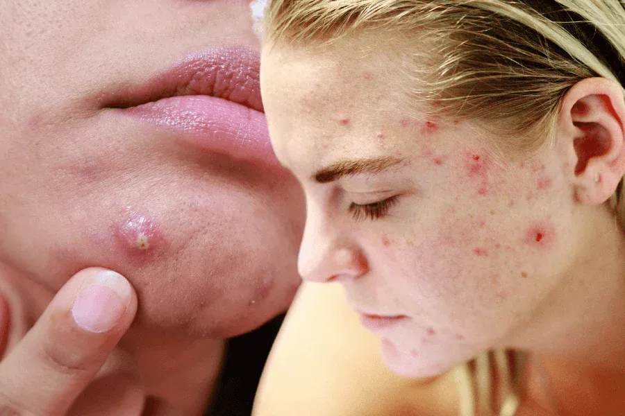Acne & Breakouts Treatment in Johar Town Lahore | The Skin Care Studio