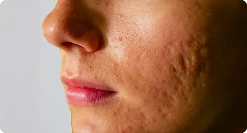Enlarged Pores Treatment in Johar Town Lahore | The Skin Care Studio