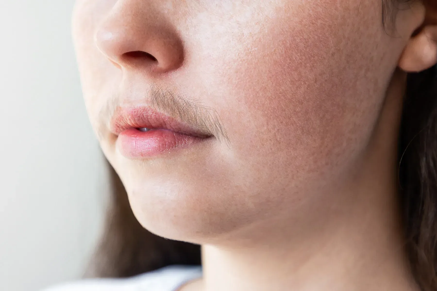 Excess Facial & Body Hair Removal in Johar Town Lahore
