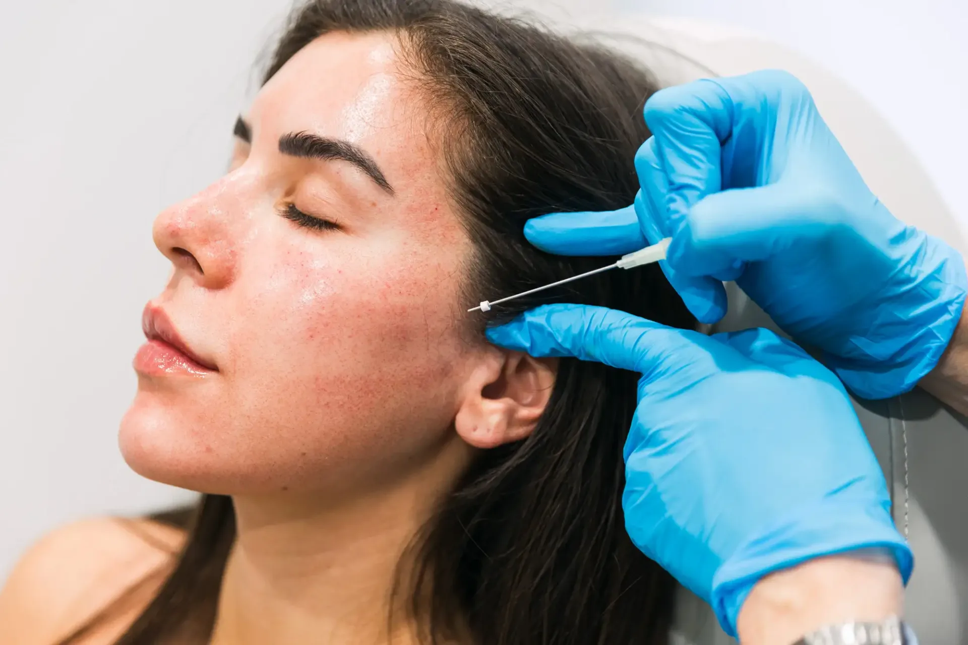 PDO Threads Treatments in Lahore | The Skin Care Studio